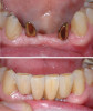 Fig 4. Esthetics are improved in this patient by milling high-strength zirconia full contour, cutting back facially, and then layering with porcelain. Although esthetics are improved, strength is decreased.