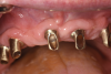 Fig 2. Traditionally cast conical abutments.