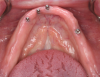 Fig 3. Pretreatment situation showing edentulous lower ridge and four existing mini implants.