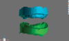 Fig 5. Edentulous ridges captured in 3D space in the correct relationship based on the position of the existing prothesis (as shown in Fig 4); the landing area notches were used for file stitching.