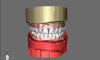 Fig 6. The new restorative set-up created using the CAD denture module based on data collected from the existing overdenture. In this step the teeth size and gingival display have been altered to improve esthetics.