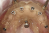 Fig 8. The surgical guide for the maxilla was constructed to be tissue-supported and retained by fixation pins. Restorative set-up was used to ensure the implant’s position was restoratively driven.