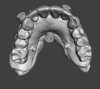 Fig 9. The surgical guide for the maxilla was constructed to be tissue-supported and retained by fixation pins. Restorative set-up was used to ensure the implant’s position was restoratively driven.