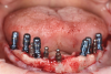 Fig 11. Implants were placed in the mandibular arch without interfering with the existing mini implants.