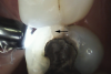 Fig 3. Transillumination of an asymptomatic maxillary left second premolar blocked by an enamel marginal ridge crack (arrow) (mesio-occlusal view).