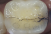 Fig 5. Methylene blue dye staining further revealing the occlusal extent of the crack shown in Fig 4.