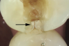 Fig 7. Existing restoration removal and crack fissurotomy revealing enamel crack (arrow) and caries in tthe tooth shown in Fig 6.