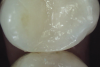 Fig 9. The remaining tooth structure supported a bonded intracoronal direct resin-based composite restoration of the tooth shown in Fig 8.