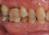 Fig 2. Pretreatment views: right lateral (Fig 2), frontal (Fig 3), and left lateral (Fig 4). Note: The maxillary right first molar (tooth No. 3) (Fig 2) would be identified as the most periodontally involved molar that was planned to be maintained.