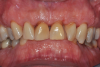 Fig 3. Pretreatment views: right lateral (Fig 2), frontal (Fig 3), and left lateral (Fig 4). Note: The maxillary right first molar (tooth No. 3) (Fig 2) would be identified as the most periodontally involved molar that was planned to be maintained.