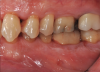 Fig 4. Pretreatment views: right lateral (Fig 2), frontal (Fig 3), and left lateral (Fig 4). Note: The maxillary right first molar (tooth No. 3) (Fig 2) would be identified as the most periodontally involved molar that was planned to be maintained.