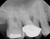 Fig 8. Periapical radiograph of the maxillary right first molar (identified as the most periodontally involved molar that was planned to be maintained).