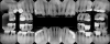 Fig 13. Periapical radiographs at 4-year follow-up. Note the absence of progressive bone loss in comparison to Fig 7, ie, no signs of active periodontal disease.