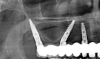 Fig 3. Tilted implants can adapt to nonalveolar anatomical bone in the interantral and pterygomaxillary region to avoid a sinus graft procedure.