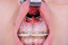 Fig 1 through Fig 3. Minimally invasive orthognathic surgery, intraoperative views. Fig 1 shows maxillary advancement and inferior repositioning; internal fixation with only two prebent plates at the canine level provide stable fixation.