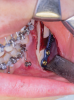 Fig 1 through Fig 3. Minimally invasive orthognathic surgery, intraoperative views. Fig 2 demonstrates mandibular advancement with counterclockwise rotation with one monocortical plate and one bicortical screw providing rigid fixation.