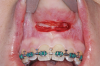 Fig 4.. Minimally invasive orthognathic surgery, intraoperative views of incisions in the maxilla (Fig 4), mandible (Fig 5), and chin (Fig 6).