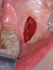 Fig 5. Minimally invasive orthognathic surgery, intraoperative views of incisions in the maxilla (Fig 4), mandible (Fig 5), and chin (Fig 6).