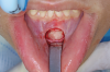 Fig 6. Minimally invasive orthognathic surgery, intraoperative views of incisions in the maxilla (Fig 4), mandible (Fig 5), and chin (Fig 6).