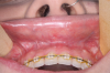 Fig 7. Postoperative views of the patient shown in Fig 4 through Fig 6, 4 months after minimally invasive orthognathic surgery showing a small fibrosis tendon that allows free movement of the lips. Healing is seen in the maxilla (Fig 7), mandible (Fig 8), and chin (Fig 9).