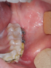 Fig 8. Postoperative views of the patient shown in Fig 4 through Fig 6, 4 months after minimally invasive orthognathic surgery showing a small fibrosis tendon that allows free movement of the lips. Healing is seen in the maxilla (Fig 7), mandible (Fig 8), and chin (Fig 9).