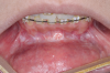 Fig 9. Postoperative views of the patient shown in Fig 4 through Fig 6, 4 months after minimally invasive orthognathic surgery showing a small fibrosis tendon that allows free movement of the lips. Healing is seen in the maxilla (Fig 7), mandible (Fig 8), and chin (Fig 9).