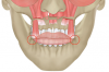 Fig 10. Illustration showing the impact of a conventional Le Fort I osteotomy on the facial muscles related to the nose and lips. Extensive periosteal elevation jeopardizes the muscle tension from the deep and superficial layers, resulting in lip mispositioning.