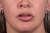 Fig 11. Example of the lip outcome and nose widening after conventional Le Fort I approaches.