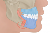 Fig 22. Illustration showing the impact of conventional mandibular osteotomies in the body of the mandible.