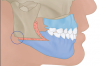 Fig 24. Illustration showing the dislocation of the anterior osteotomy with the maintenance of the mandibular body intact, avoiding defects and allowing angle projection.