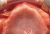 Fig 2. Preoperative intraoral situation of a highly atrophic maxillary arch.