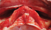 Fig 3. Intraoperative intraoral situation. After crestal incision, an extended full-thickness flap is raised to make bone tissue clearly visible where custom-made subperiosteal implant is to be placed.