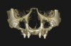 Fig 4. After a 3D bone scan with CBCT, virtual 3D model of individualized, patient-specific implants is produced.