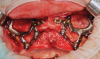 Fig 7. Intraoperative intraoral situation showing fixation of left and right individualized implants with insertion of mini screws. In the maxilla, the same concept as used for Le Fort I fracture fixation plates is used. The implants are custom-made to perfectly adapt to the patient’s specific anatomy.