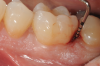 Fig 3. Distal probing depth of 10 mm at tooth No. 19.