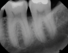 Fig 4. Periapical radiograph revealing a distal intrabony defect at tooth No. 19.