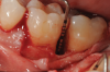 Fig 6. 5-mm-deep distal intrabony defect at tooth No. 19.