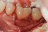 Fig 9. Combination therapy in which rhPDGF-BB was combined with FDBA (Fig 8) and packed into the bone defect (Fig 9).