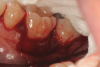 Fig 11. Combination therapy included the use of an amnion-chorion membrane, which was customized (Fig 10) and placed over the interproximal aspect of the bone defect (Fig 11).