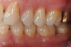 Fig 13. Stability of the soft tissues at 1-year follow-up.