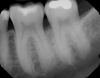 Fig 14. Periapical radiograph revealing healed bone at 1-year follow-up.