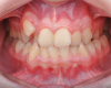 Fig 2. Intraoral initial frontal photograph. A severe posterior bilateral crossbite was present, associated with a width discrepancy between the upper and lower arches. Lower buccal segments were tipping mesially and in relation to moderate lower arch crowding and required uprighting. Lower buccal shelf miniscrews would be used to provide anchorage for the correction in the mandible. 
v