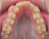 Fig 3. Initial maxillary arch photograph. A very narrow and transverse-deficient arch was associated with severe upper crowding and a totally blocked-out upper right cuspid.