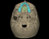 Fig 4. Digitally planned insertion of four miniscrews. Digital planning enables precision in miniscrew placement and allows the TADs to be placed in optimal positions without risks to the roots of neighboring teeth.