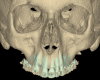 Fig 11. The amount of transverse expansion can be measured in the CBCT. The frontal view of the CBCT is shown before the treatment (Fig 11) and after the expansion was completed (Fig 12). Ideally, parallel expansion is desired. However, both clinically and in CBCT images, the expansion is often more extensive in the anterior region and follows a triangular shape.