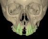 Fig 12. The amount of transverse expansion can be measured in the CBCT. The frontal view of the CBCT is shown before the treatment (Fig 11) and after the expansion was completed (Fig 12). Ideally, parallel expansion is desired. However, both clinically and in CBCT images, the expansion is often more extensive in the anterior region and follows a triangular shape.