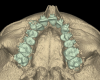 Fig 13 and Fig 14. CBCT upper arch view before 
(Fig 13) and after (Fig 14) miniscrew-assisted palatal expansion with lateral wall expander, demonstrating a substantial change in maxillary width. It is useful to measure the changes in width in various arch regions between the pre- and post-expansion CBCTs. Such comparison measurements could be made in the anterior, cuspid, premolar, and first molar regions.