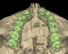 Fig 14. CBCT upper arch view before 
(Fig 13) and after (Fig 14) miniscrew-assisted palatal expansion with lateral wall expander, demonstrating a substantial change in maxillary width. It is useful to measure the changes in width in various arch regions between the pre- and post-expansion CBCTs. Such comparison measurements could be made in the anterior, cuspid, premolar, and first molar regions.