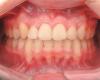 Fig 16. Intraoral frontal photograph 2 years after completion of treatment. The severe posterior bilateral crossbite was corrected, the width discrepancy between the upper and lower arches was fully addressed, and the lower buccal segments were uprighted through the use of buccal shelf miniscrews. Good class I molar and canine relation with adequate overjet and overbite was achieved. Note that the upper right lateral incisor had a minor relapse, which may have been due to insufficient root torque during fixed orthodontics. In a critical evaluation of the case, more opposite-torque correction in the upper right lateral incisor and cuspid might have been beneficial.