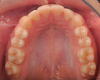 Fig 17. Maxillary arch photograph 2 years after completion of treatment. Note a broad arch with corrected initial severe upper crowding. Note also that the upper right cuspid that had been blocked out was now ideally placed in the arch.